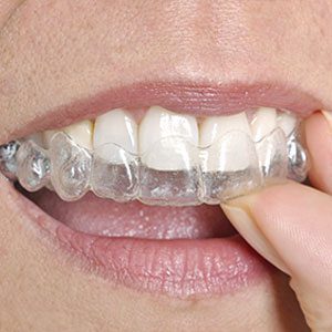 treating crooked teeth with Invisalign in Plantation Florida