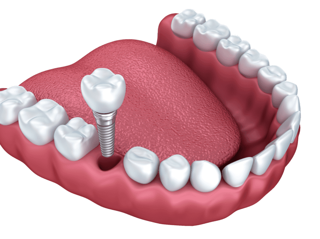 affordable dental implants in Plantation FL by Dr. Dham
