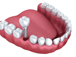 inexpensive dental implants in Plantation FL by Dr. Dham