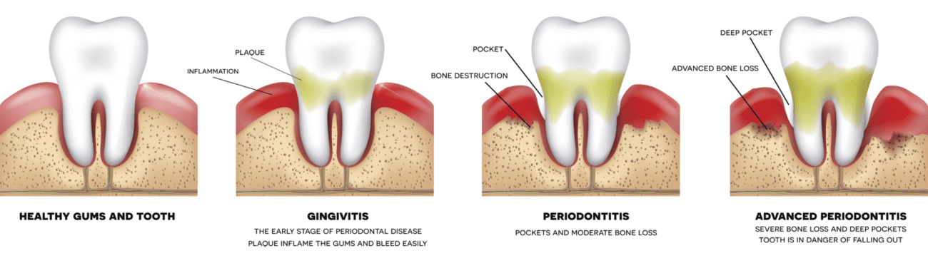 gum disease progression plantation fl