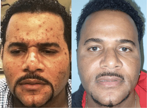 Real patients after PRF treatment westside dental center plantation fl