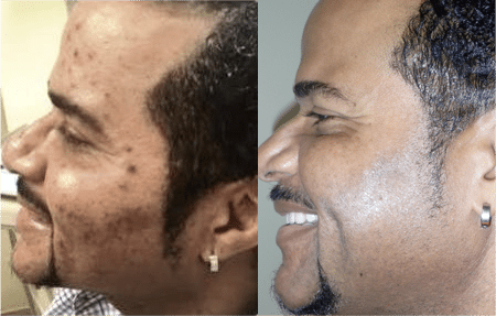 Real patients before PRF treatment westside dental center plantation fl