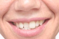 is Invisalign right for me? plantation fl