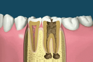 root canal process in Broward County, Florida