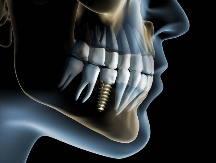 single tooth dental implant, plantation fl