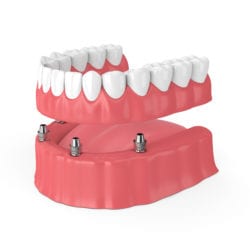 Implant Supported Dentures Near Me in Plantation, Florida 