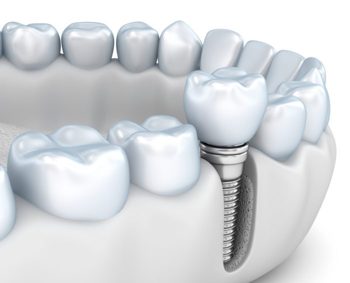 Benefits of Dental Implants | Implant Dentists Near Me in Plantation