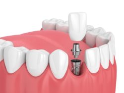 plantation, florida dental implants