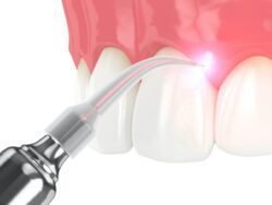 laser dentistry in plantation, florida