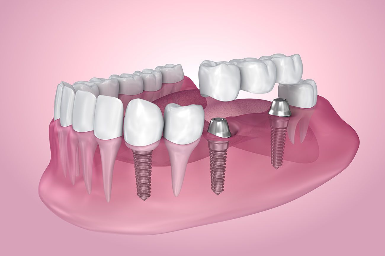 different dental implants in Davie Florida