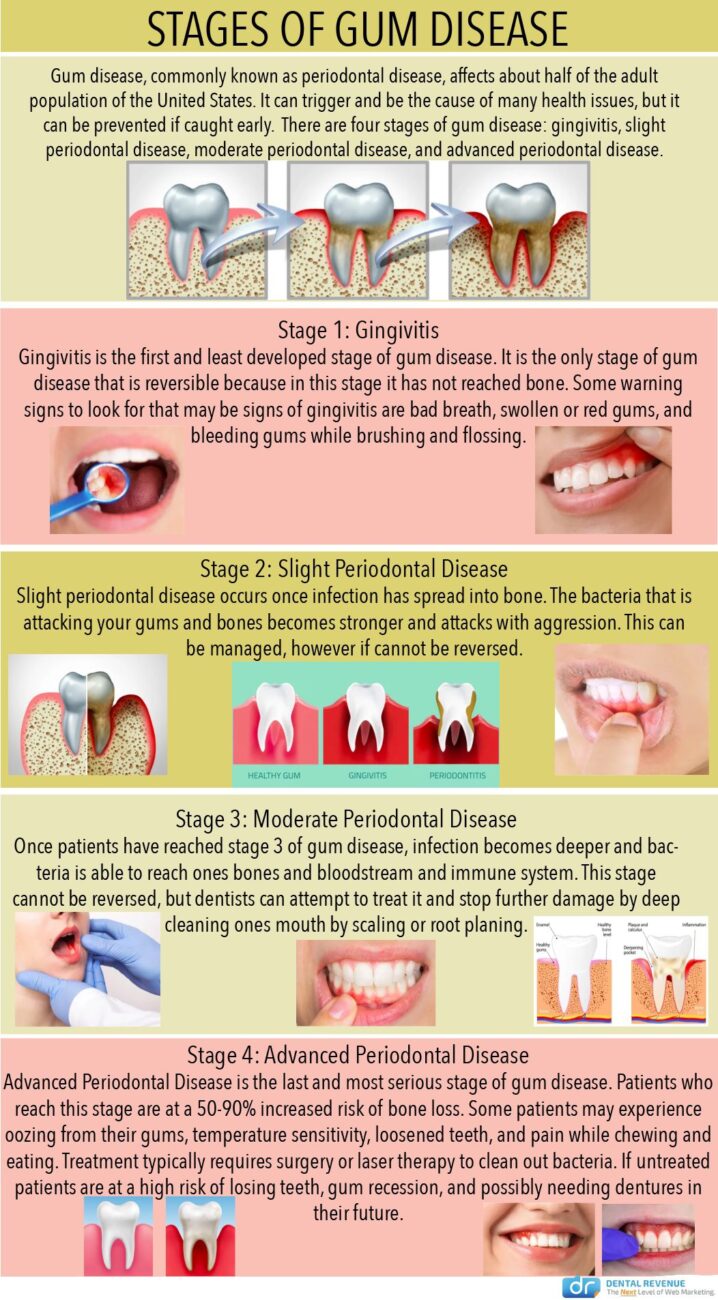 Stages Of Gum Disease Infographic