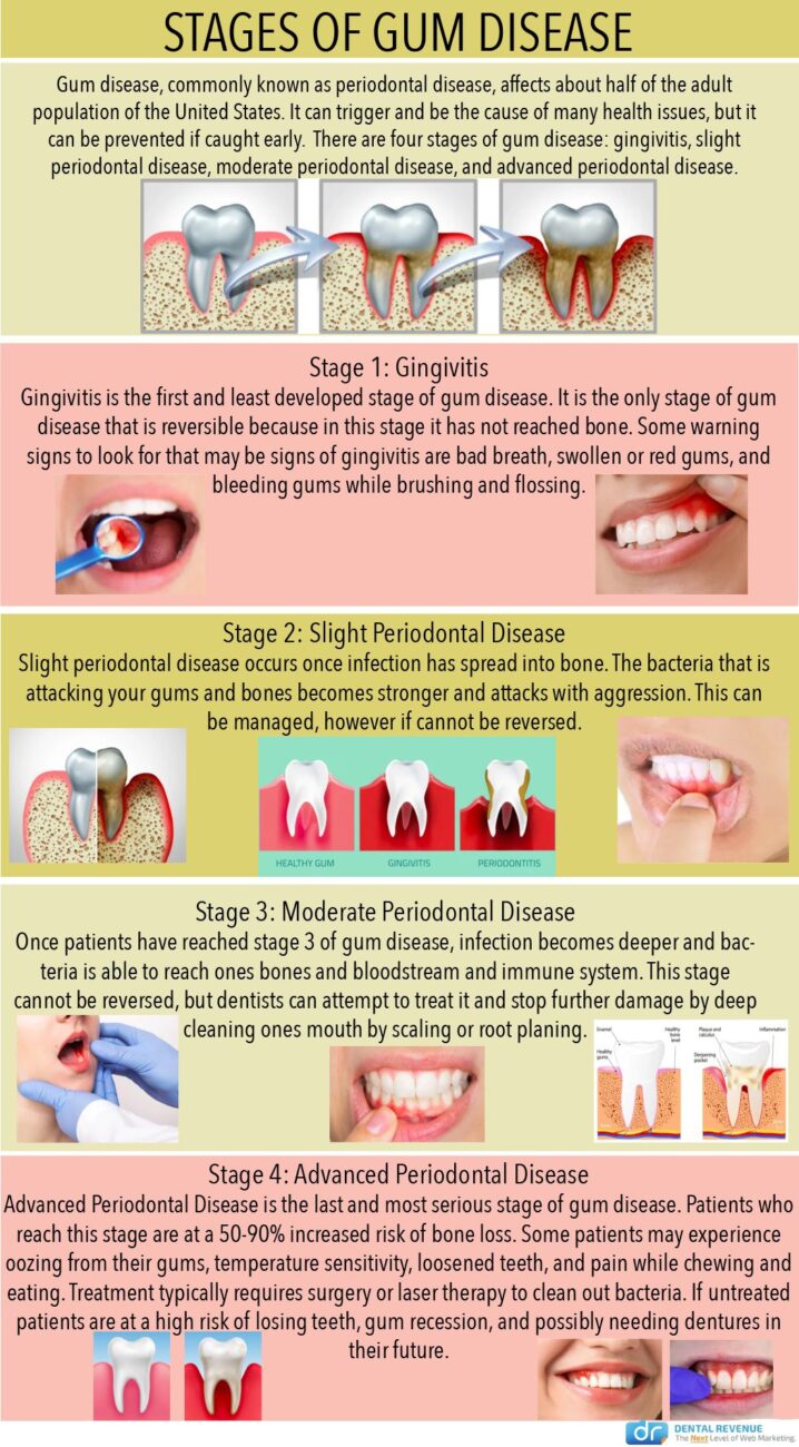 Gingivitis (Gum Inflammation) - Causes, Symptoms and Treatment