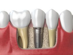 preserve jawbone after tooth loss with dental implants