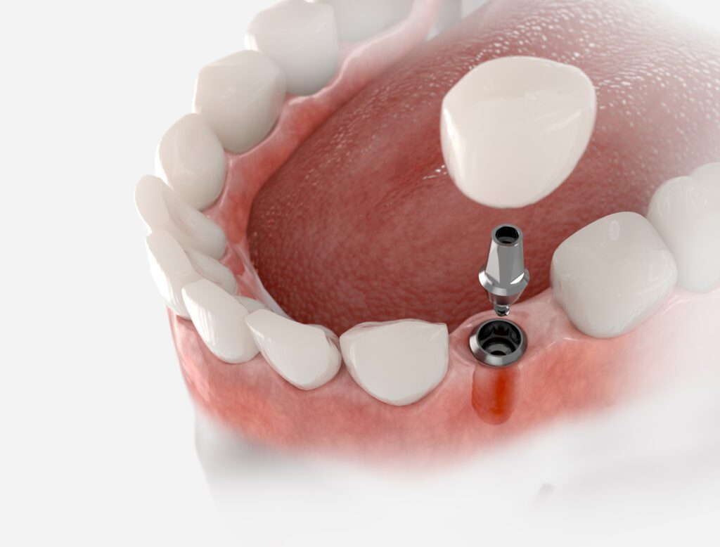 Single dental crown