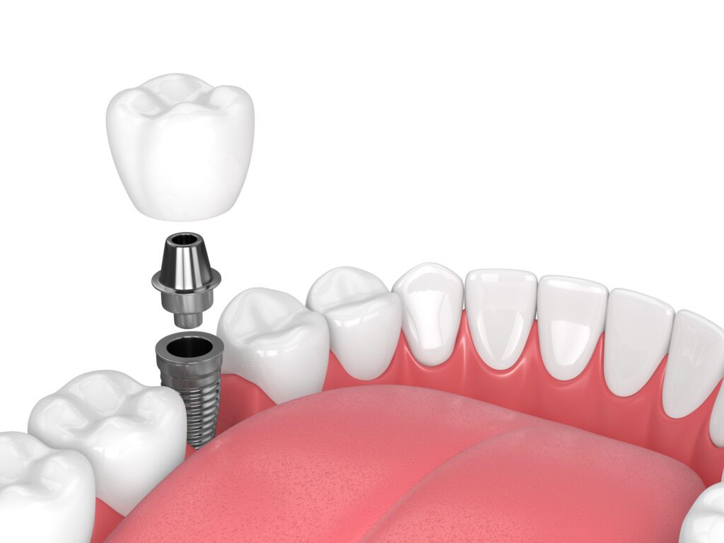 Dental Implants Protect Your Jaw