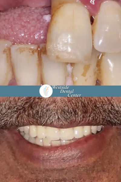 Before and after dental services at Coastal Cosmetic & Implant Dentistry