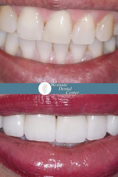 Before and after dental services at Coastal Cosmetic & Implant Dentistry