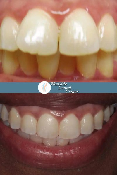 Before and after dental services at Coastal Cosmetic & Implant Dentistry