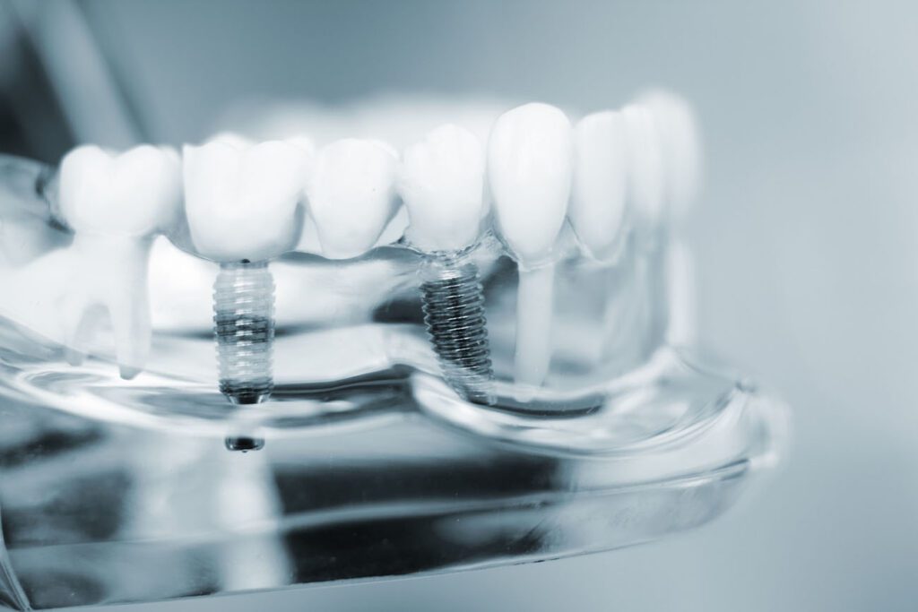 Choosing the right dental bridge involves various factors, including the location of the missing teeth and your overall oral health.