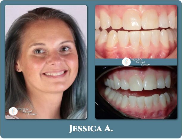 Before and after Invisalign in Plantation FL