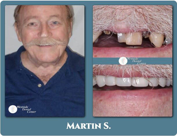 Before and after dental implants in Plantation FL