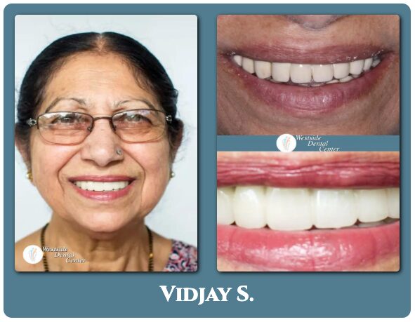 Patient before and after Snap-on-Smile