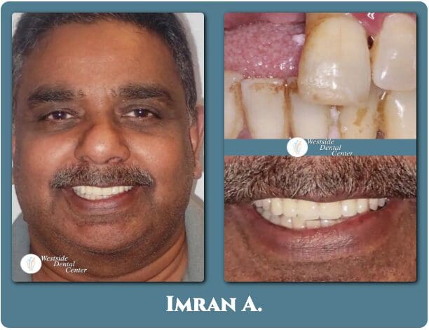 Before and after dental implants in Plantation and Davie FL