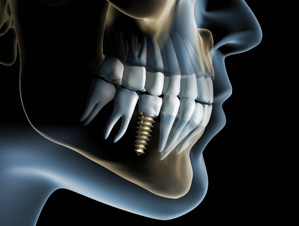 Single Tooth Implant Replacement
