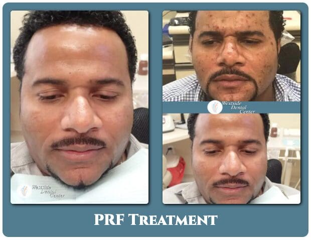 Patient before and after PRF treatment