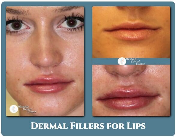 Patient before and after lip fillers at Westside Dental Center