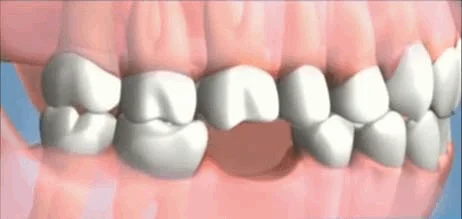 Replace lost teeth near me in Plantation, FL