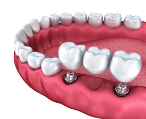 Dental Bridge Procedure in Plantation, FL