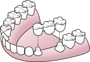 Dental bridge anchored to adjacent teeth