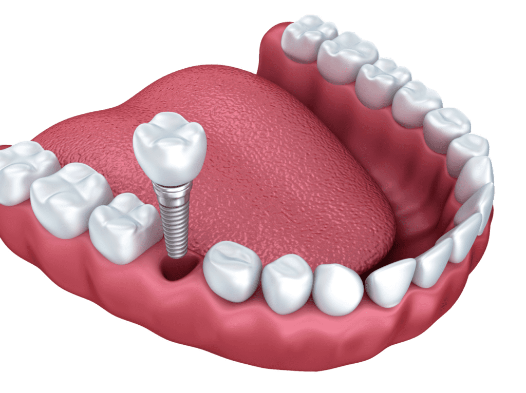 affordable dental implants in Plantation FL by Dr. Dham