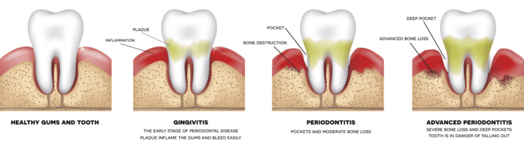 gum disease treatment in Plantation Florida
