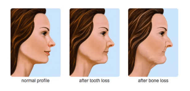 Bone Loss after Missing Teeth