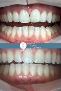 Invisalign Case Ariana