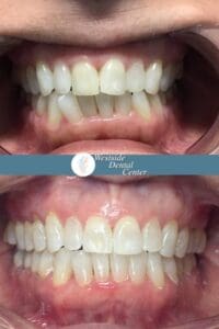 Invisalign Case Evergista