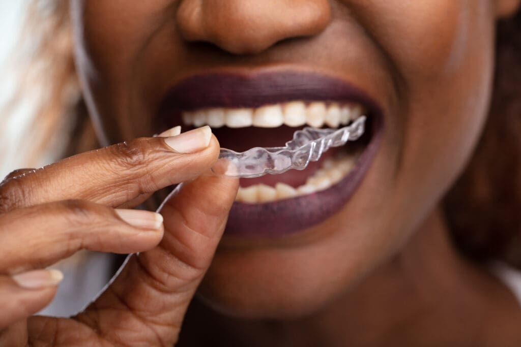 Benefits of Invisalign in Plantation FL
